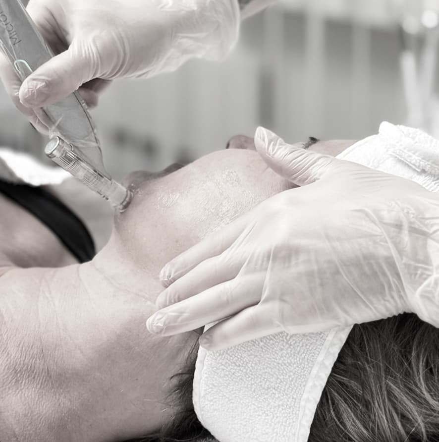 Microneedling Behandlung
